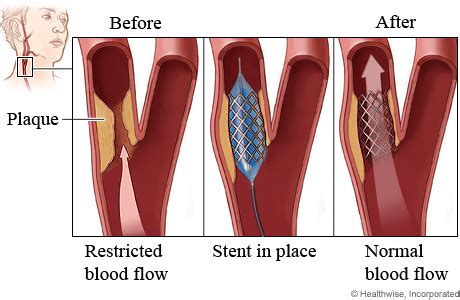 Carotid artery stenting | Cigna