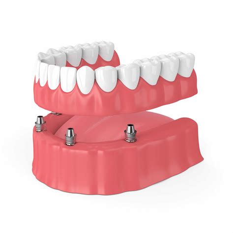 What are snap-on-dentures? Dental implants in Coral Springs