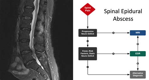 emDOCs.net – Emergency Medicine EducationSpinal Epidural Abscess: Challenges to Diagnosis and ...