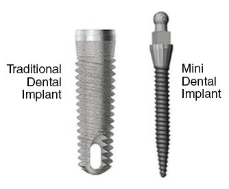 Mini Dental Implants - Waco Family Dentistry