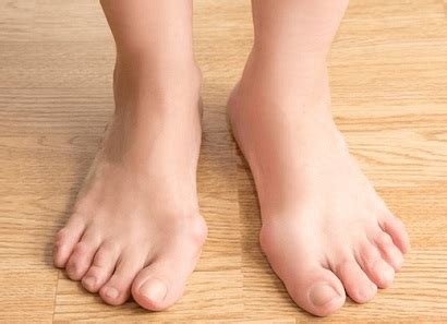 Foot Bunion: Causes, Symptoms & Treatment - Foot Pain Explored