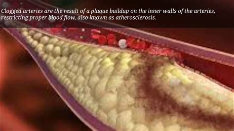 How to clean arteries of plaque. - Ayurvedic treatment for blocked arteries. - YouTube