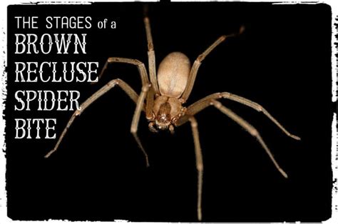 Brown Recluse Bite: Pictures, Stages, Symptoms & Treatment - HubPages