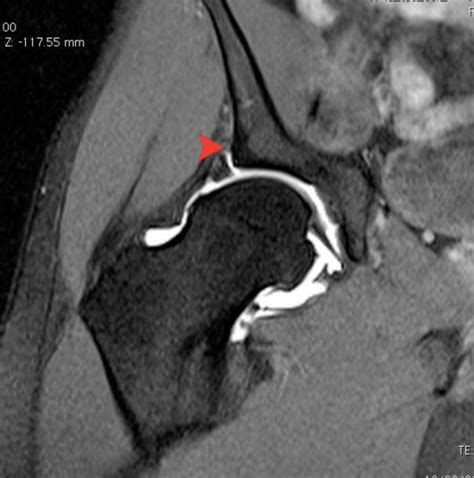 labral tear hip