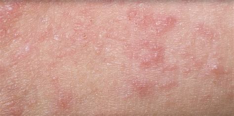 Consensus statement outlines new pathway for adult eczema