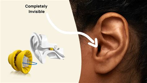 An Audiologist's Review Lyric Hearing Aids