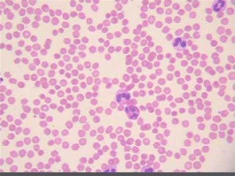 Blood film from case 3 showing spherocytes and echinocytes. | Download Scientific Diagram