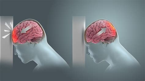 What is the Difference Between Ice Pick and Thunderclap Headache ...