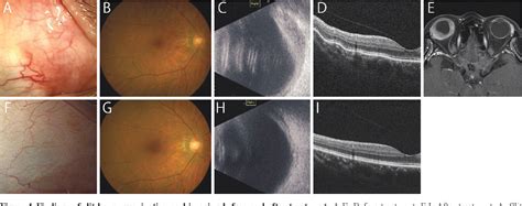 Figure 1 from A case of nodular posterior scleritis simulating ...