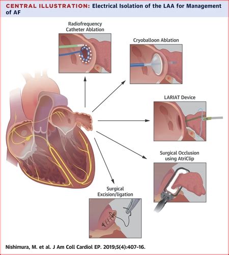 Left Atrial Appendage Electrical Isolation as a Target in Atrial Fibrillation | JACC: Clinical ...