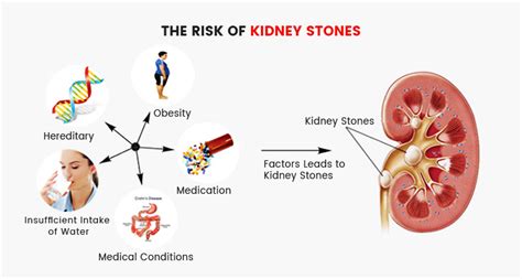 Kidney Stones: Ouch! Causes, Symptoms, Treatment - Knoxville Hospital & Clinics