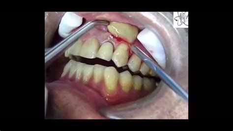Upper Buccal Abscess Incision & Drainage - YouTube