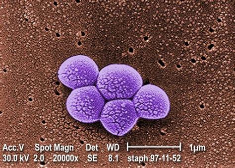 MRSA Infection - Symptoms, Diagnosis, MRSA Skin Infection Treatment