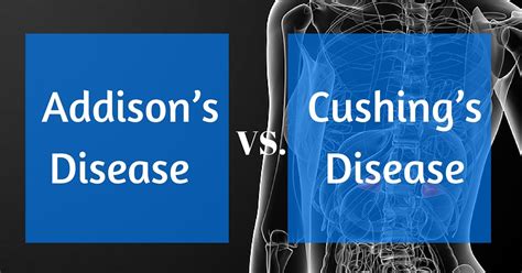 Addison's Disease vs Cushing's Disease - RNpedia