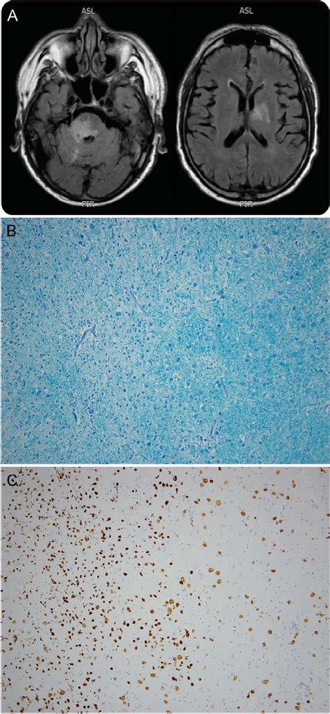 Figure Brain MRI and biopsy specimens from the pontine lesion | Download Scientific Diagram