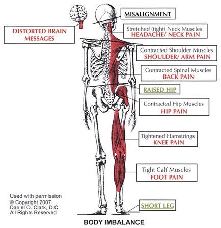 Pinched Nerve In The Neck | Doctors | Specialists | Treatments | Boise ...