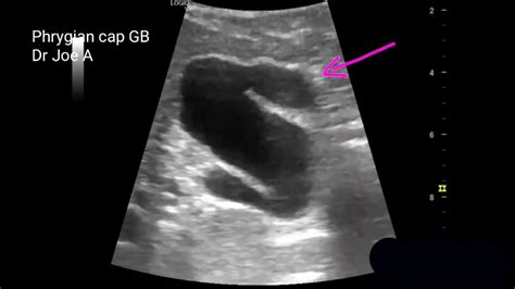 Phrygian cap Gallbladder ultrasound video - YouTube