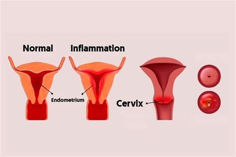 Endometritis: Symptoms, Causes & Treatment - Tua Saúde