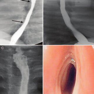 (PDF) Savary Dilation Is Safe and Effective Treatment for Esophageal ...