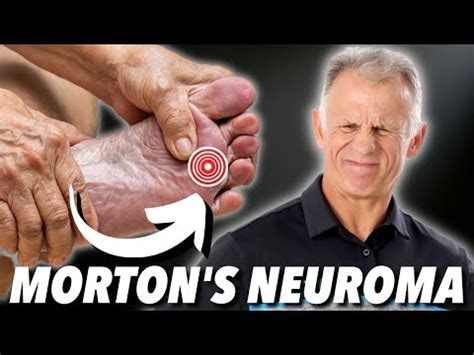 Strengthening Exercises For Morton's Neuroma