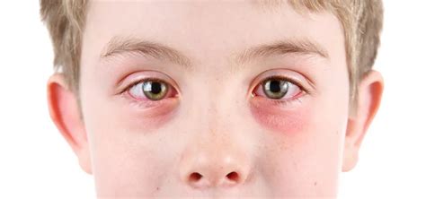 Eye Allergies | Ophthalmologists in COUNTY NAME, STATE | Michigan ...