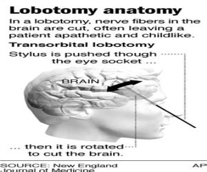 WORLD INFO: Lobotomy is a neurosurgical procedure