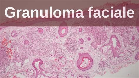 Granuloma Faciale - Pathology mini tutorial - YouTube