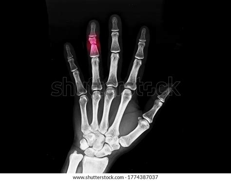 Hand Xray Showing Open Fracture Middle Stock Photo 1774387037 | Shutterstock