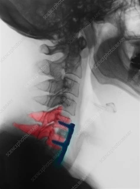 Cervical xray showing spinal fusion, C5, C6, C7 - Stock Image - F018/9114 - Science Photo Library