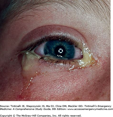 Bacterial conjunctivitis