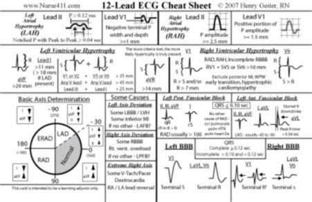 12 best images about ECG interpretation, etc on Pinterest | Cartoon ...