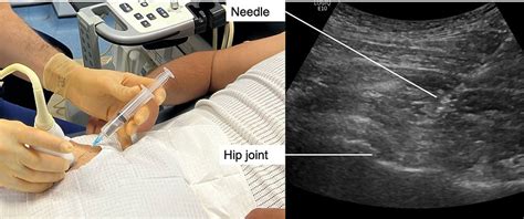 Hip osteoarthritis Cortisone injection | Musculoskeletal Ultrasound & Injections clinic