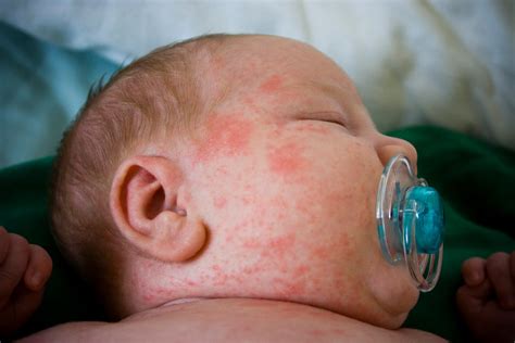 Baby Rash on Face, Cheeks and Neck - Please Doctor