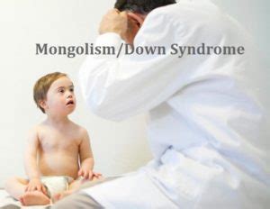 Mongolism - Down Syndrome Treatment – Neurotherapy India