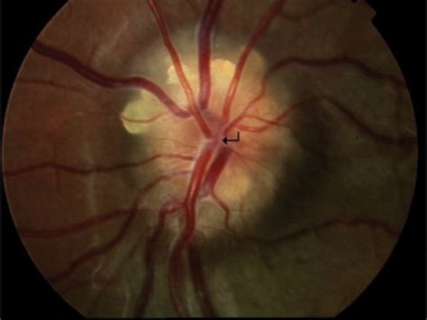 Surface and buried optic nerve head drusen. The disc is elevated and... | Download Scientific ...