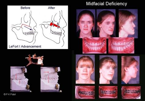 QUADRANGULAR LEFORT 1 OSTEOTOMY? HIGH LEVEL LEFORTS?