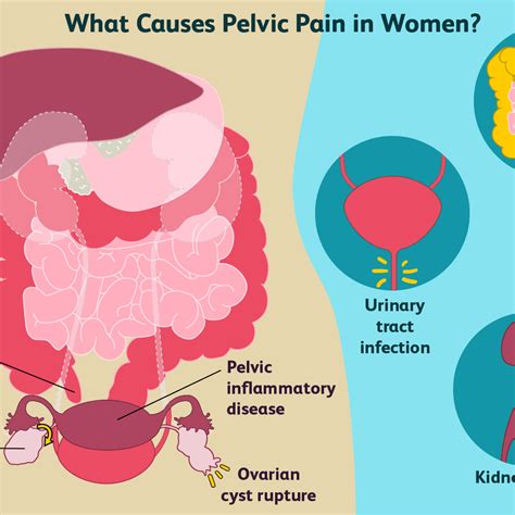Severe Pelvic Pain During Pregnancy / Pelvic Pain During Pregnancy Parents - Pelvic pain is ...