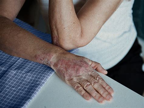 Mild Psoriasis On Hands