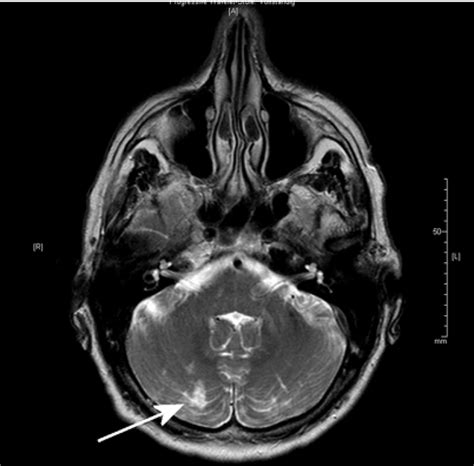 MRI of a 61-year-old patient with embolic silent brain infarction in ...