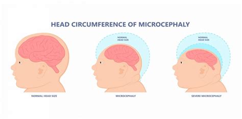 What Is Microcephaly? What You Need To Know | BellyBelly