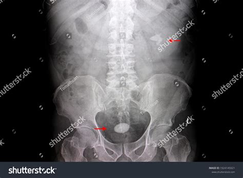 Kidney Stone Xray Photos, Images and Pictures