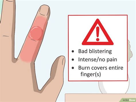 How to Treat a Blistering Burn on Your Finger: 14 Steps | Burn blister ...