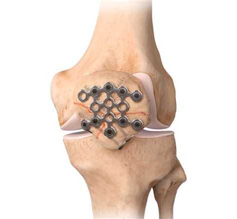 Arthrex - Patella Fracture