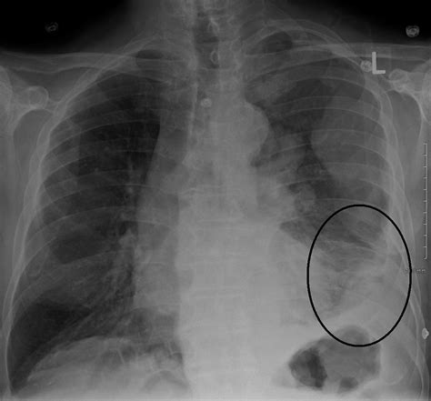 Chest X-ray Interpretation | A Structured Approach | Radiology | OSCE