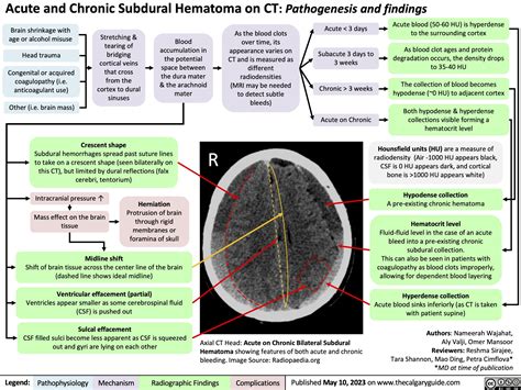 Subdural Hematoma on CT | Calgary Guide