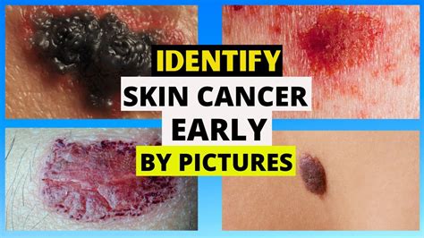 Stages Of Skin Cancer