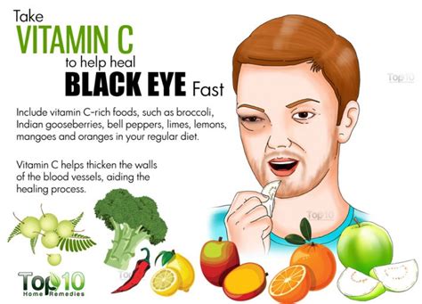 How to Get Rid of a Black Eye as Fast as Possible | Top 10 Home Remedies