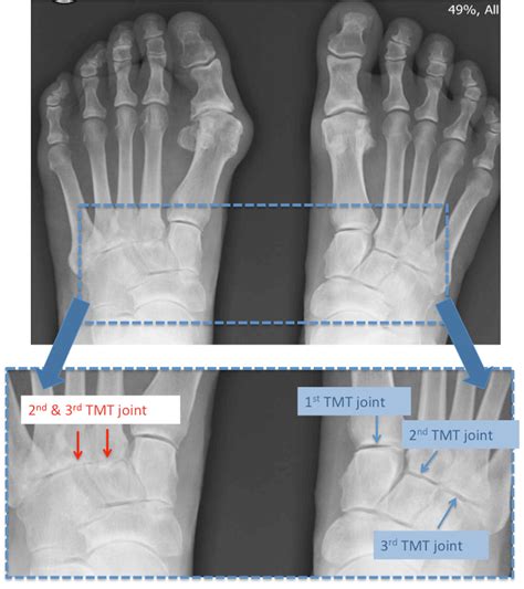 Midfoot Arthritis | Mr Malik Orthopaedic Consultant | LFAC