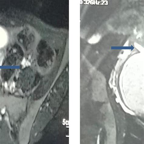 -MRI Pelvis demonstrates, (A) uterus didelphys, (B) hematometrocolpos... | Download Scientific ...