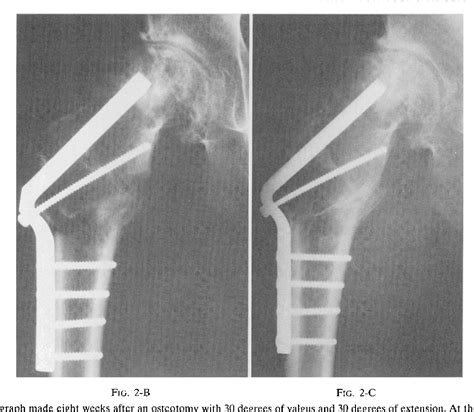 Figure 2 from Proximal Femoral Osteotomy as the Primary Operation for Young Adults Who Have ...